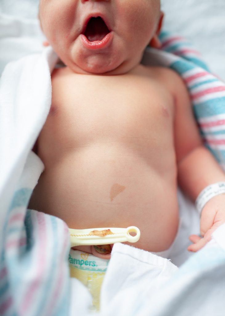 Newborn baby belly with birthmark